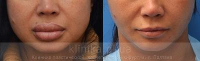 Хирургические методы коррекции формы и объема губ (булхорн, хейлопластика) до и после операции, фото 1