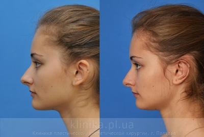 Otoplasty before and after operation, photo 2