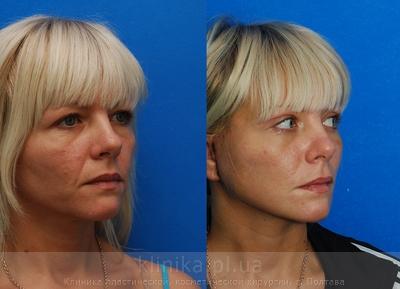 Facelifting before and after operation, photo 3