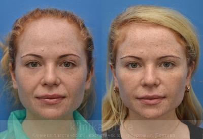 Ліпофілінг обличчя до і після операції, фото 1