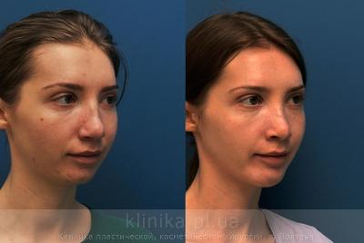 Сorrection volume and shape of the chin before and after operation, photo 5