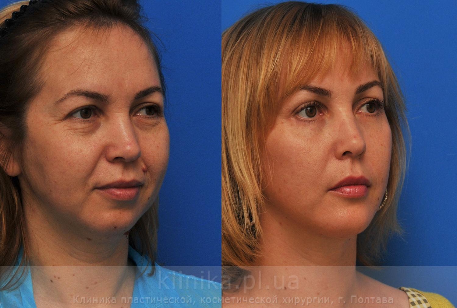 Лифтинг лица клиника. Круговая подтяжка лица до и после. Фейслифтинг для лица. Кругован подтнгка лица.