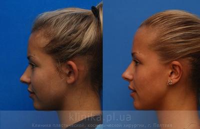 Otoplasty before and after operation, photo 9