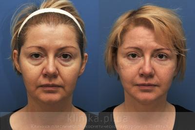 Facelifting before and after operation, photo 1