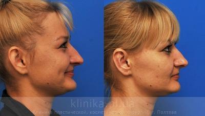 Otoplasty before and after operation, photo 4