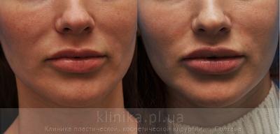 Surgical correction of the shape and volume of the lips (chalinoplasty) before and after operation, photo 5