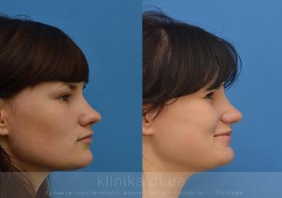 Correction of the tip and wings of the nose before and after operation, photo 2