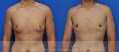 Treatment of gynecomastia before and after operation, photo 4