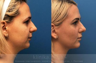 Ліфтинг м'яких тканей обличчя нитками Aptos до і після операції, фото 1