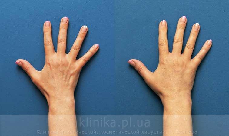 Ліпофілінг кистей рук