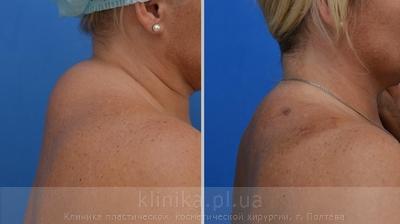 Liposuction before and after operation, photo 7