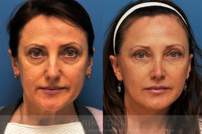 Facelifting before and after operation, photo 3