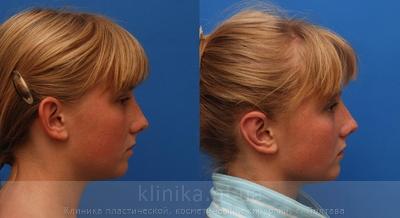Пластика ушных раковин (отопластика) до и после операции, фото 7