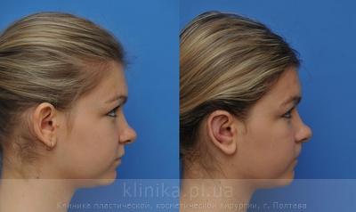 Пластика ушных раковин (отопластика) до и после операции, фото 5