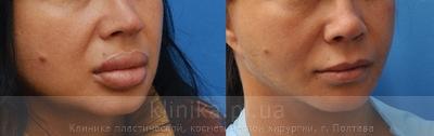 Surgical correction of the shape and volume of the lips (chalinoplasty) before and after operation, photo 2