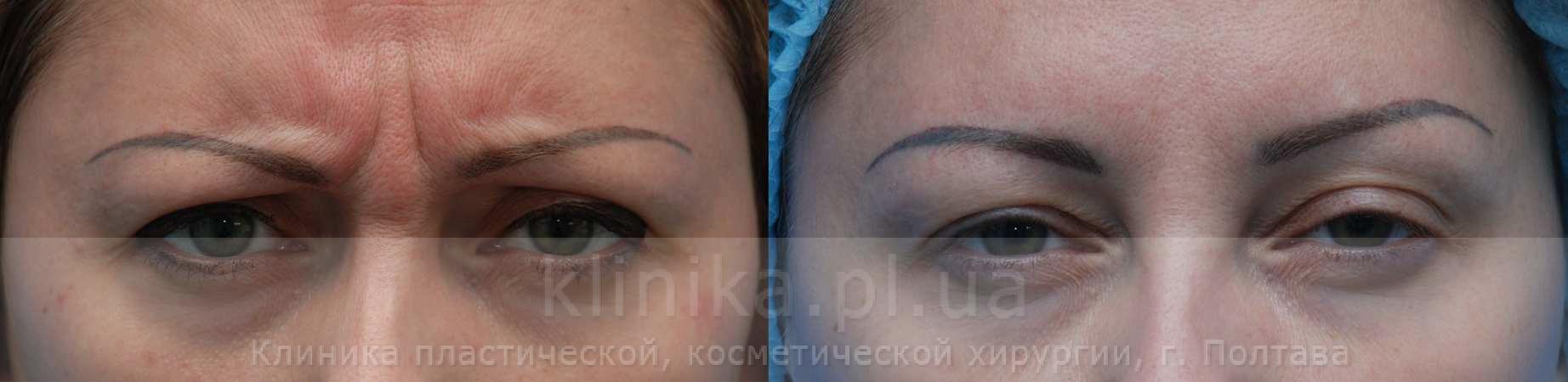 The correction of mimic wrinkles.