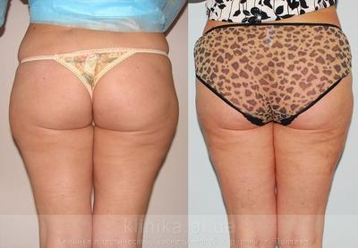 Liposuction before and after operation, photo 7