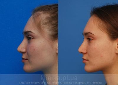 Correction of the tip and wings of the nose before and after operation, photo 6