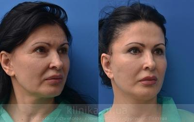 Facelifting before and after operation, photo 5
