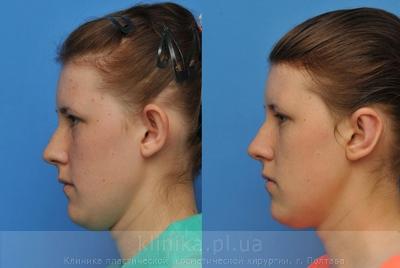 Otoplasty before and after operation, photo 8