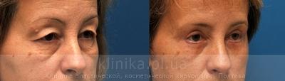 Blepharoplasty before and after operation, photo 1