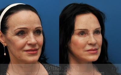 Facelifting before and after operation, photo 7