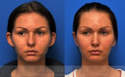 Otoplasty before and after operation, photo 5