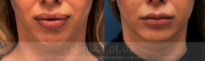 Хирургические методы коррекции формы и объема губ (булхорн, хейлопластика) до и после операции, фото 3