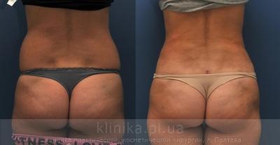 Liposuction before and after operation, photo 2