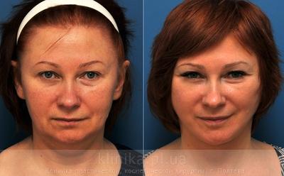 Facelifting before and after operation, photo 8