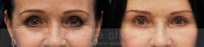 Blepharoplasty before and after operation, photo 1