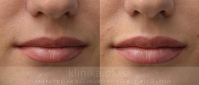 Contour correction before and after operation, photo 1