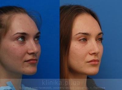 Correction of the tip and wings of the nose before and after operation, photo 5