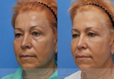 Face lipofilling before and after operation, photo 2