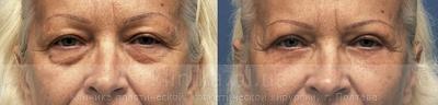 Blepharoplasty before and after operation, photo 8