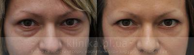 Blepharoplasty before and after operation, photo 7