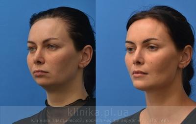 Сorrection volume and shape of the chin before and after operation, photo 1