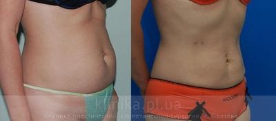 Liposuction before and after operation, photo 9