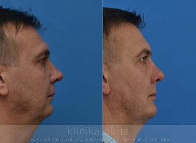 Установка импланта подбородка до и после операции, фото 5