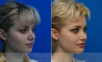 Сorrection volume and shape of the chin before and after operation, photo 9