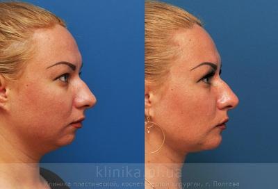Ліфтинг м'яких тканей обличчя нитками Aptos до і після операції, фото 2