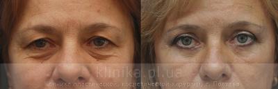 Blepharoplasty before and after operation, photo 5