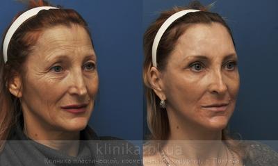 Facelifting before and after operation, photo 2