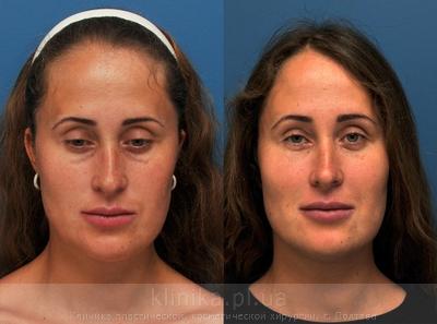 Face lipofilling before and after operation, photo 7