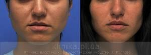 Surgical correction of the shape and volume of the lips (chalinoplasty) image 3886