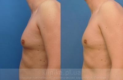 Treatment of gynecomastia before and after operation, photo 3