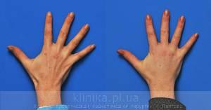 Lipofilling of the hands image 3002