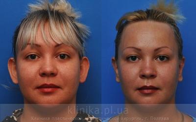 Otoplasty before and after operation, photo 3