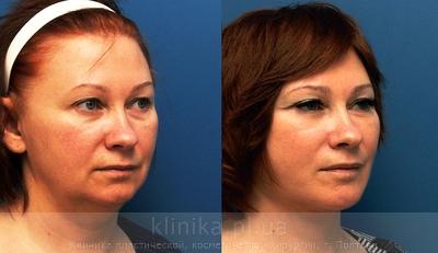 Facelifting before and after operation, photo 9