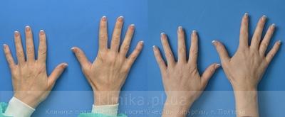Lipofilling of the hands before and after operation, photo 3